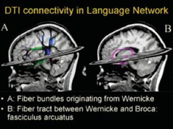 Image: Combination of fMRI of language and diffusion MRI fiber tractography in a healthy subject (Photo courtesy of Prof. Stefan Sunaert, Leuven University Hospital, Belgium).